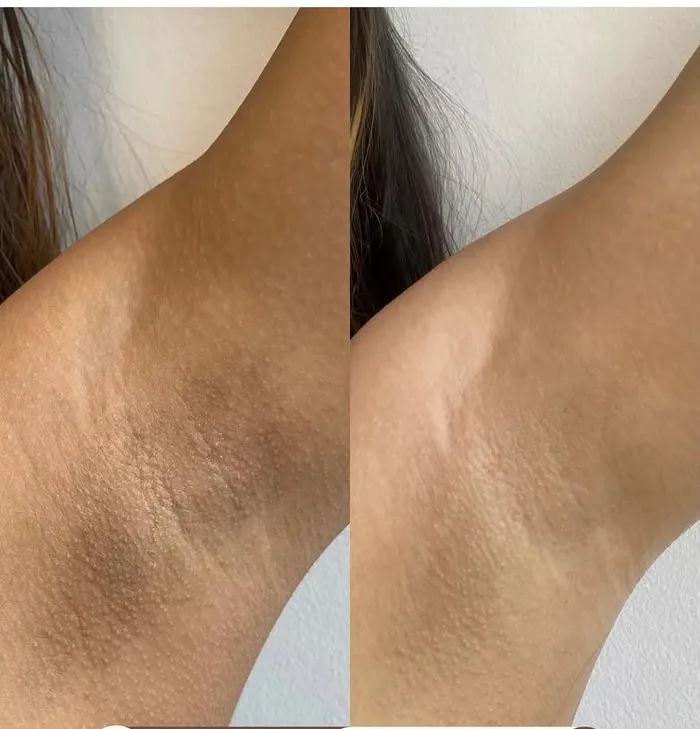 Antes e depois clareamento de manchas na axila