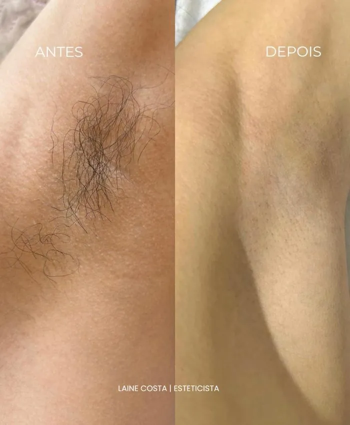 Antes e depois depilação com cera