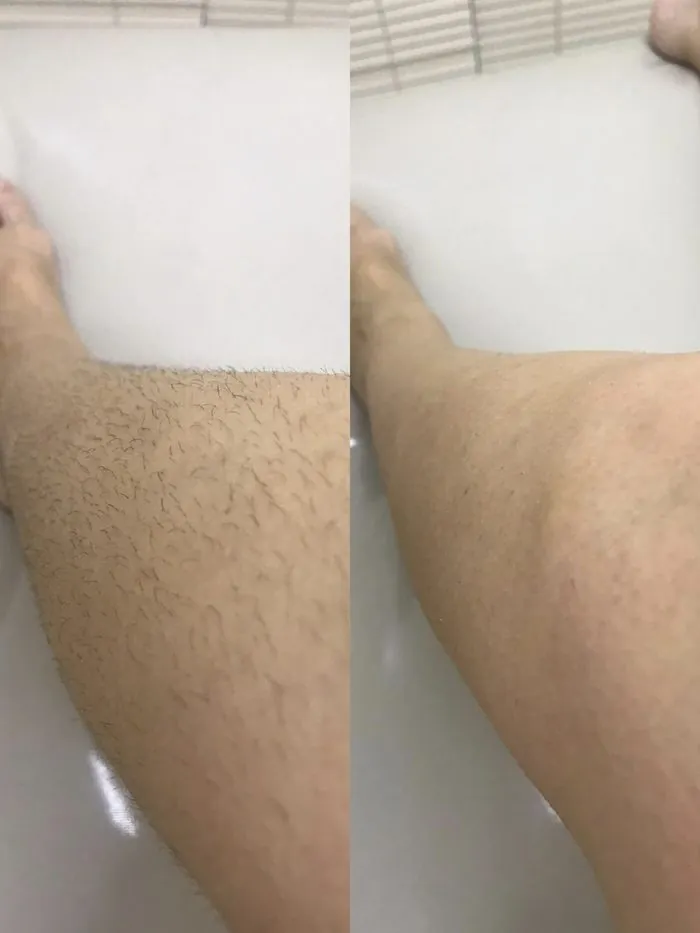 Antes e depois depilação a laser na perna